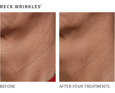 Neck Wrinkes - Before and After 4 treatments.